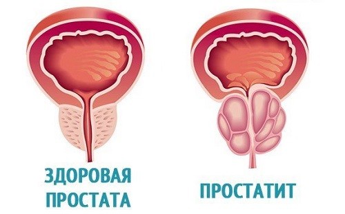 Симптомы простатита