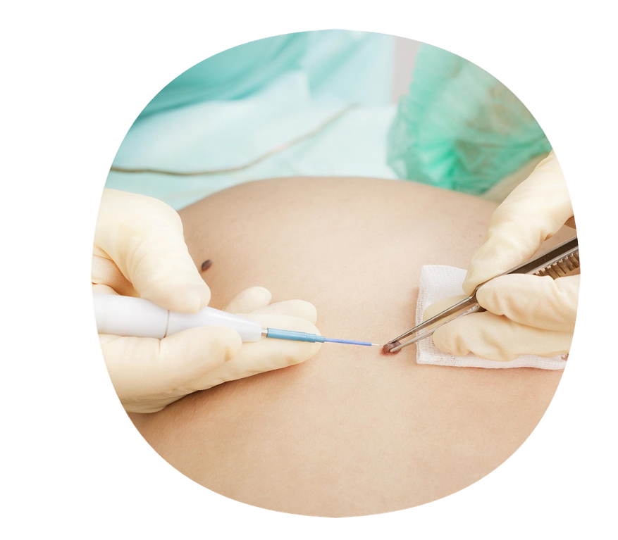 Биопсия кожи